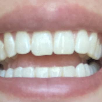 same reviewer showing after using the pen with noticeably whiter teeth