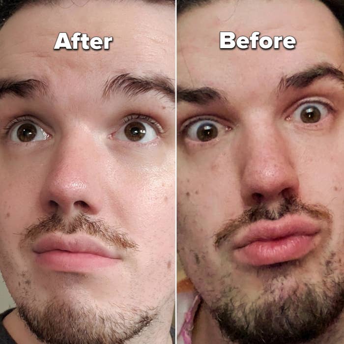 Reviewer photos comparing their clearer, more hydrated skin after using the water gel (left) and their dry, blotchy skin before using it (right)