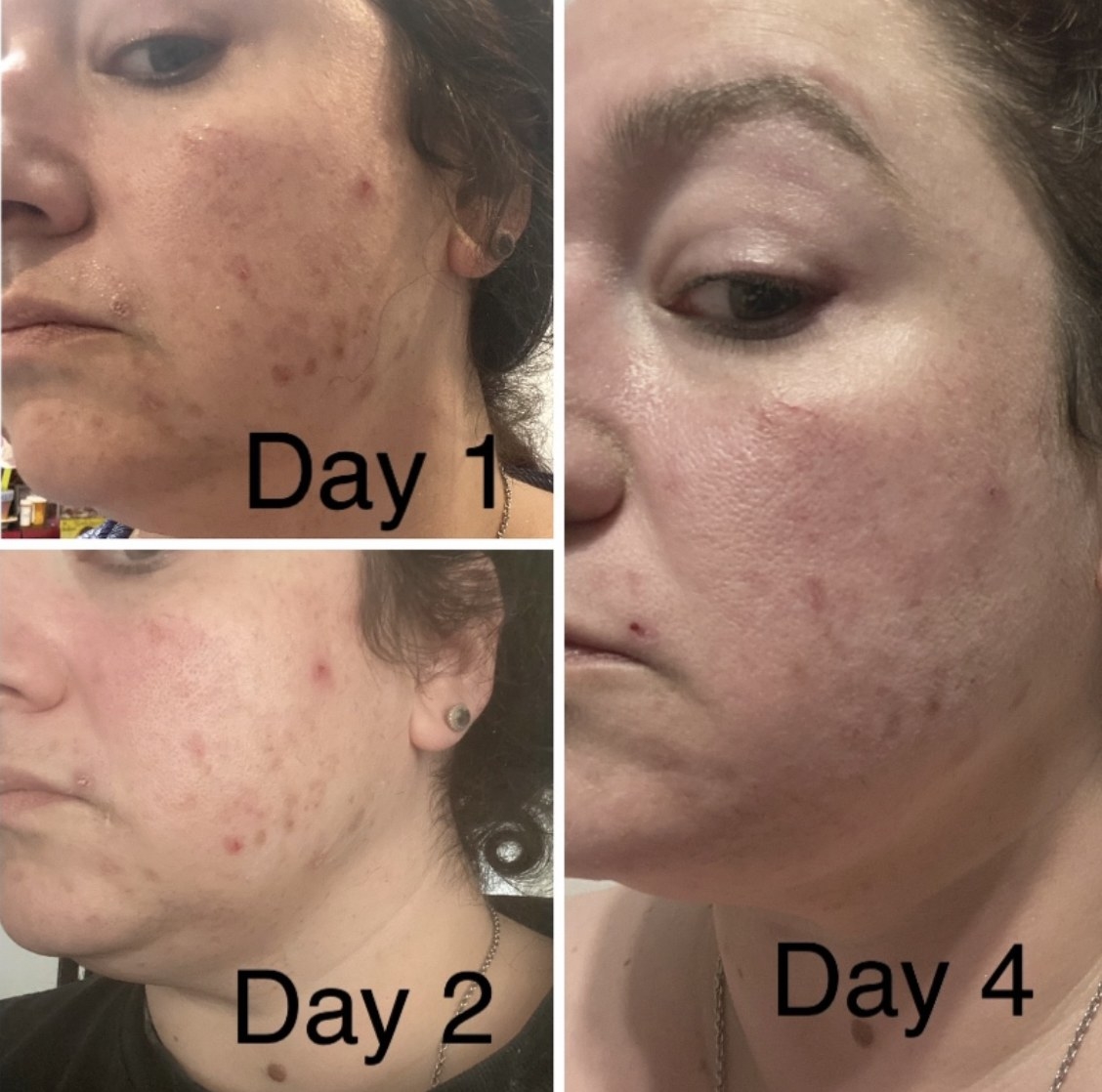 before and after four days of using the acne treatment