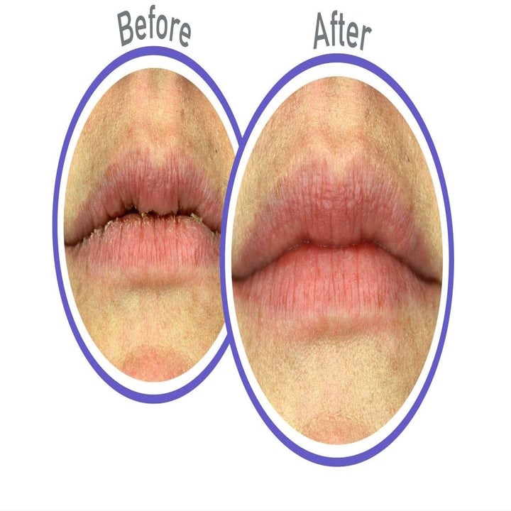 Before and after photos of chapped lips and smooth, hydrated lips after using the treatment