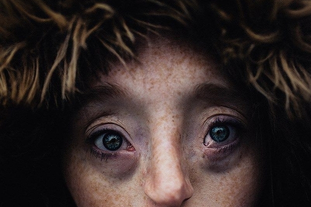 This Little Girl's Big, Beautiful Eyes Are Due To A Rare Genetic