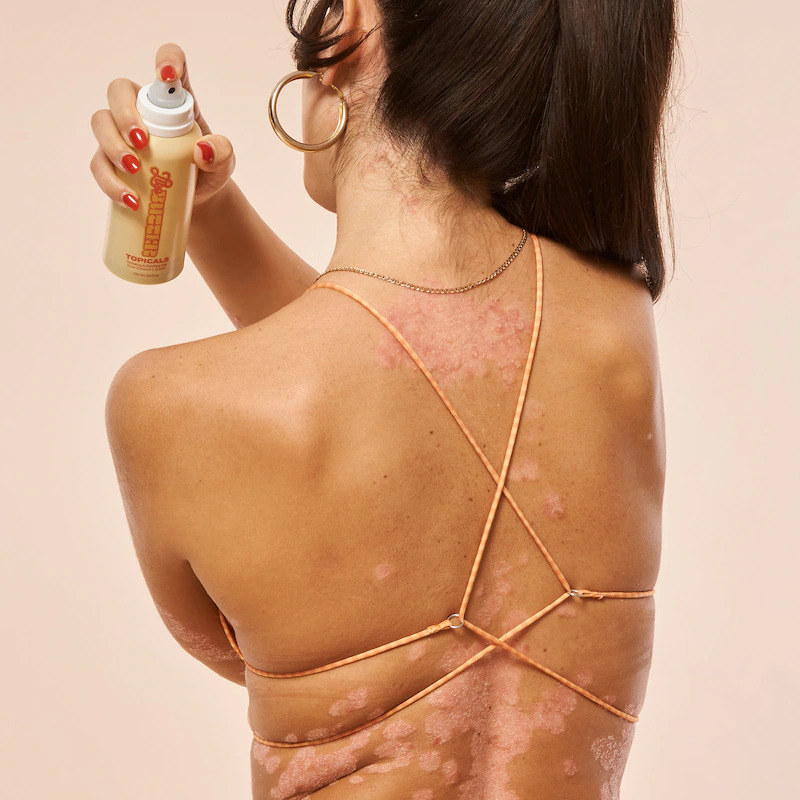 model with eczema on their back spraying the mist on their body