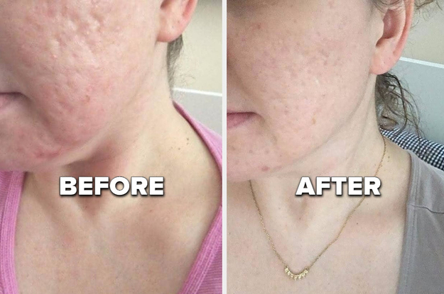 L: reviewer with acne scars and pitted skin on their cheek R: the same reviewer with noticeably smoother skin after using glycolic acid peel