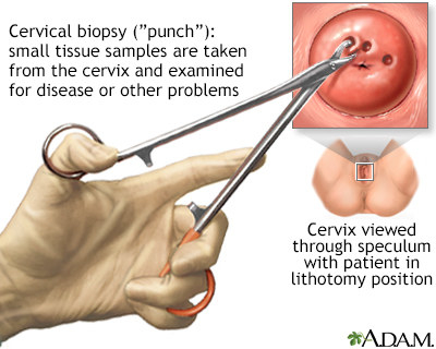 A diagram of a cervix being biopsied