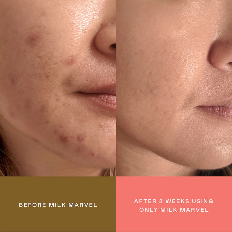 before photo of a model&#x27;s cheek with red acne scarring and an after photo of the same cheek with all the scarring gone after 8 weeks of using the serum