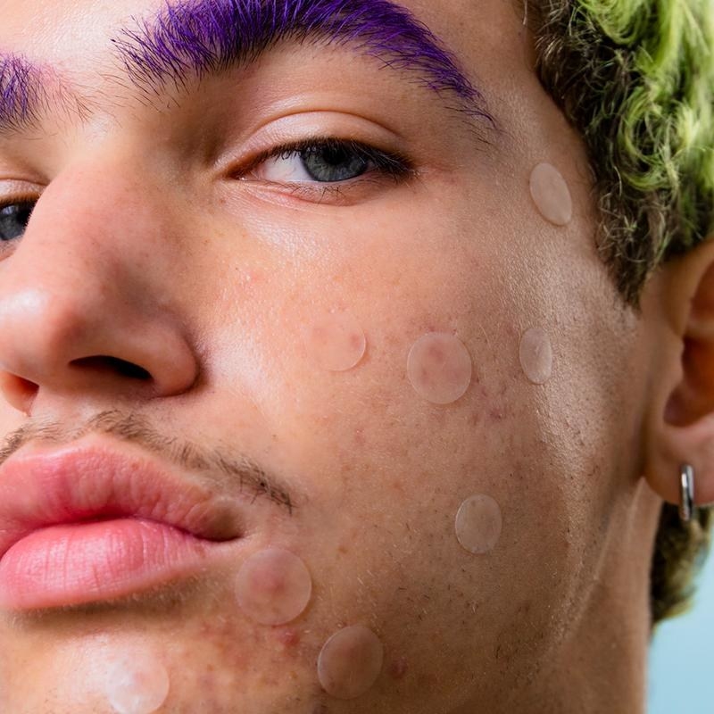 model wearing the clear circle patches on their cheek pimples