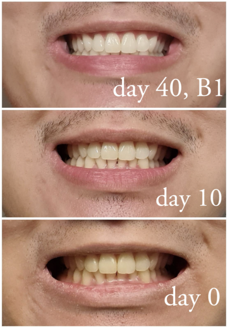 A series of customer review before and after photos showing their teeth yellow to white in 40 days