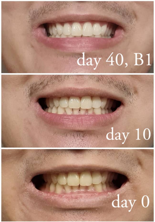 A reviewer's teeth before and after using the strips showing their teeth yellow to white in 40 days