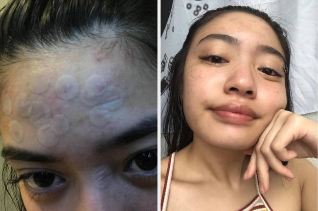 reviewer before-and-after showing forehead acne that are no longer there