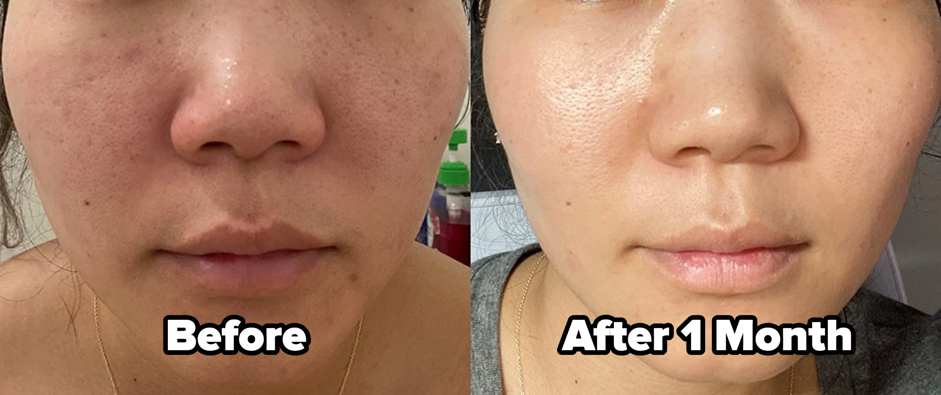 on the left, a reviewers skin with hyperpigmentation on the cheeks labeled &quot;before&quot; and, on the right, the same reviewer with their skin clear and glowy labeled &quot;after 1 month&quot;