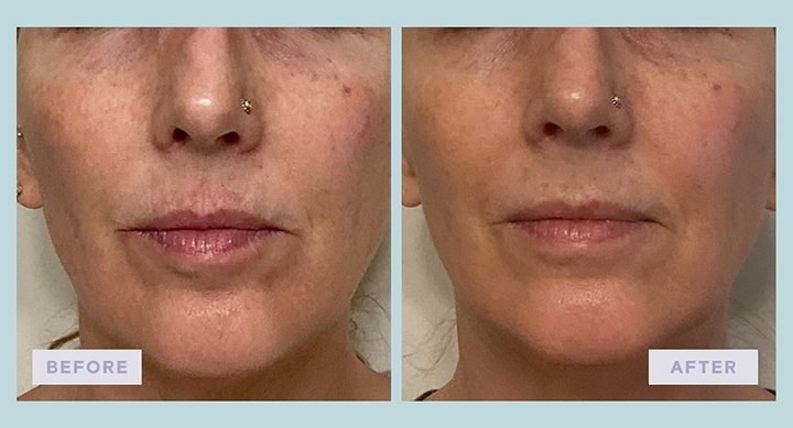 a before and after of brighter skin on an adult after using the mask