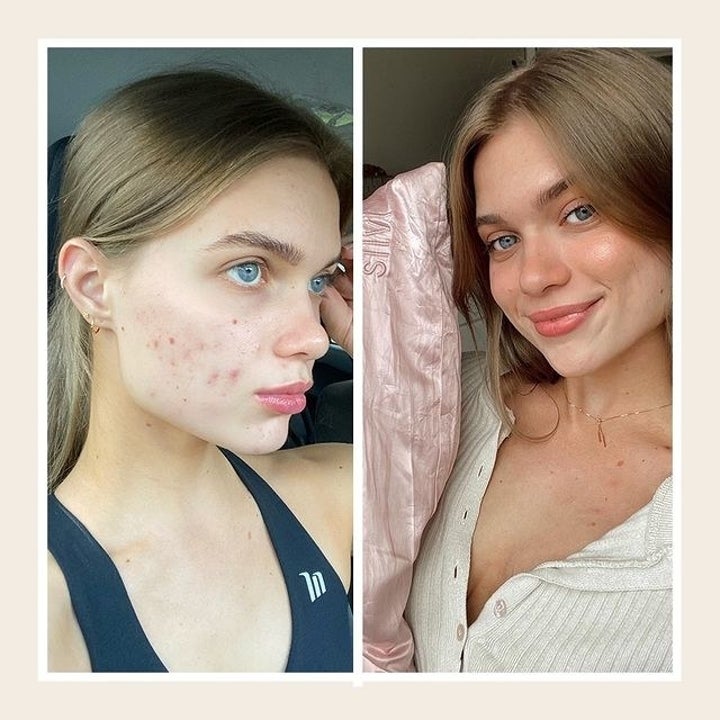 A before and after showing that the pillowcase helped clear a person's acne dramatically