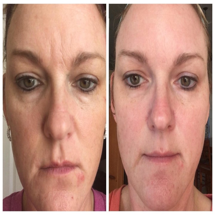 on left, reviewer's face with acne spots and redness across cheeks, nose, and chin on right, same facial areas with less acne spots and redness after they used the vitamin C serum