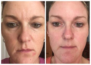 on left, reviewer's face with acne spots and redness across cheeks, nose, and chin on right, same facial areas with less acne spots and redness after they used the vitamin C serum