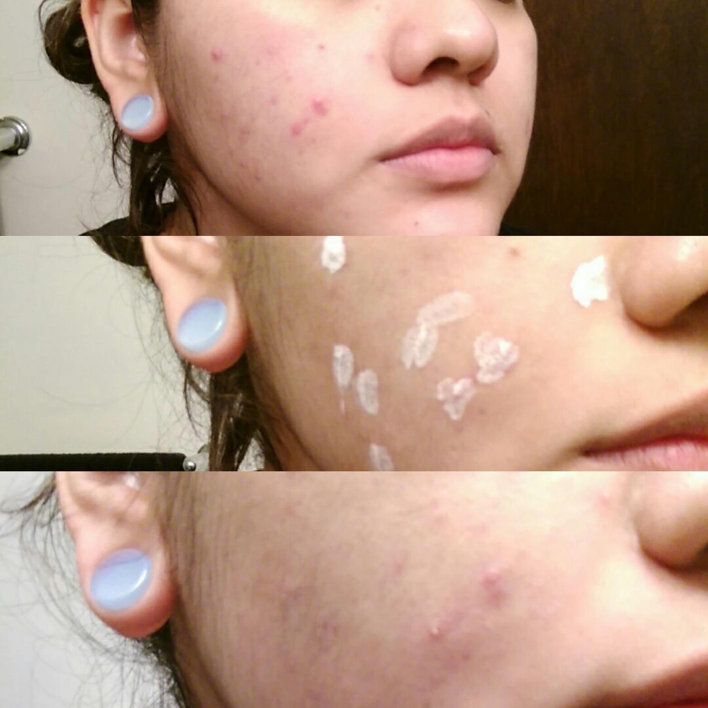 Reviewer time-lapse photos showing breakouts on their face (top), the lotion applied to the blemishes (middle), and clearer skin after using the lotion (bottom)