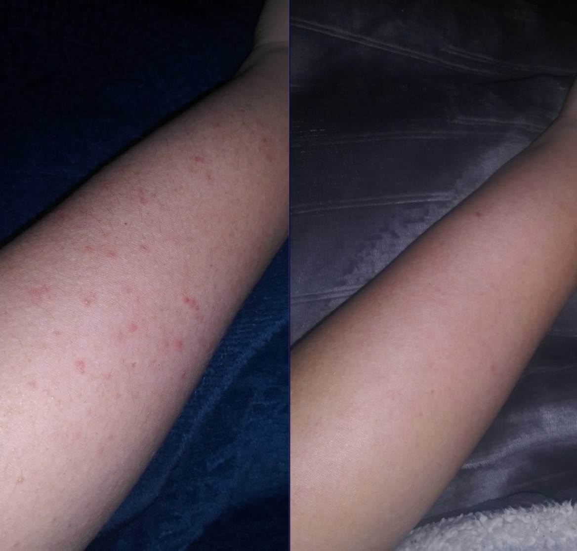 reviewer showing their arm before and after using the KP lotion, showing their bumps significantly reduced after consistent use
