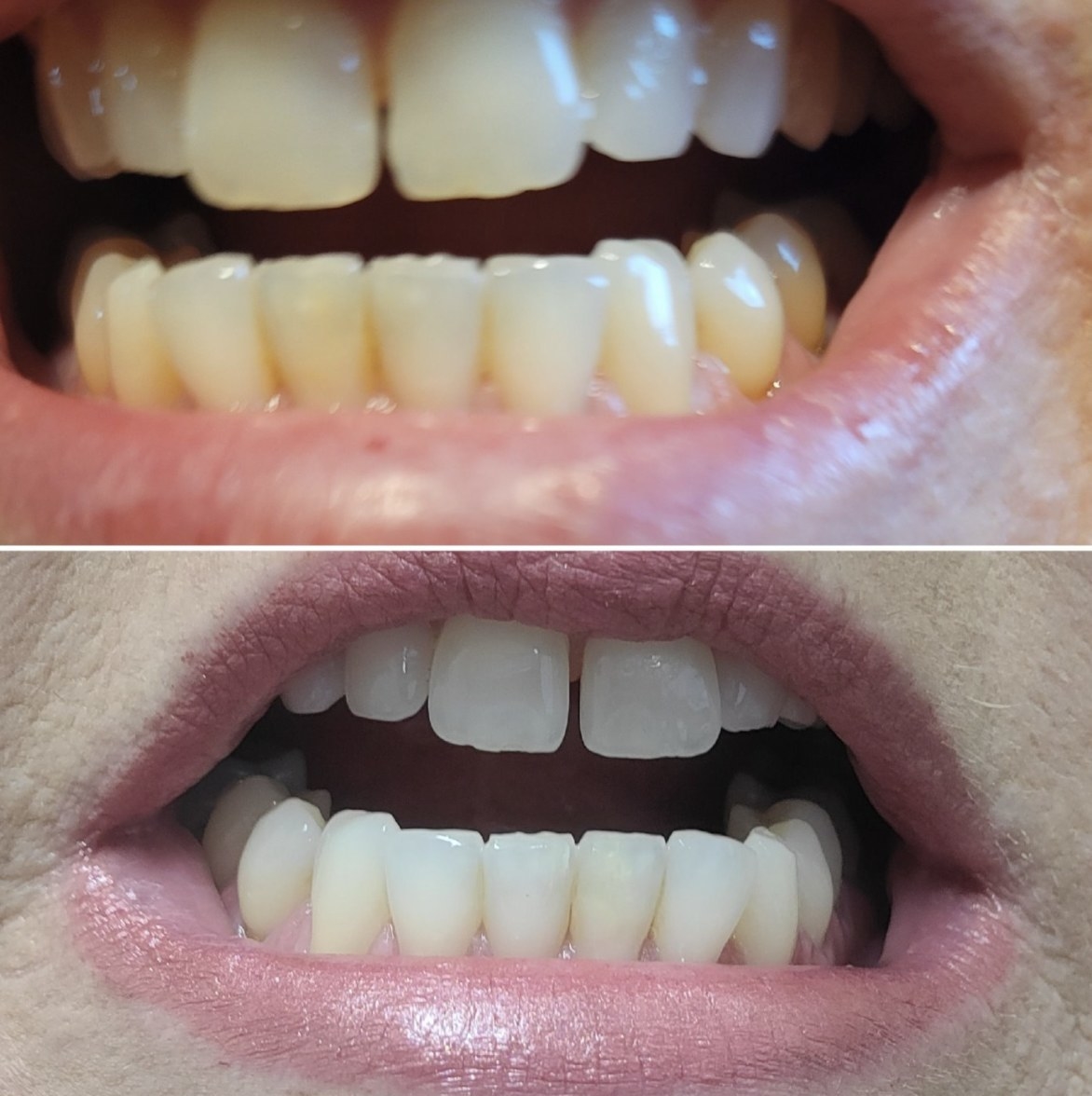 reviewer photo showing their smile before and after using the whitening pen, with visible results