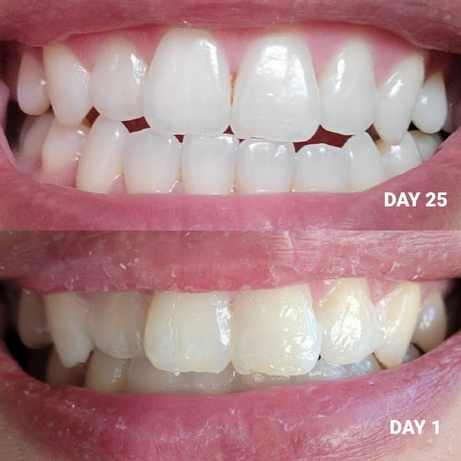 bottom: before photo of reviewer with yellow teeth / top: after photo 25 days later showing their teeth are much whiter