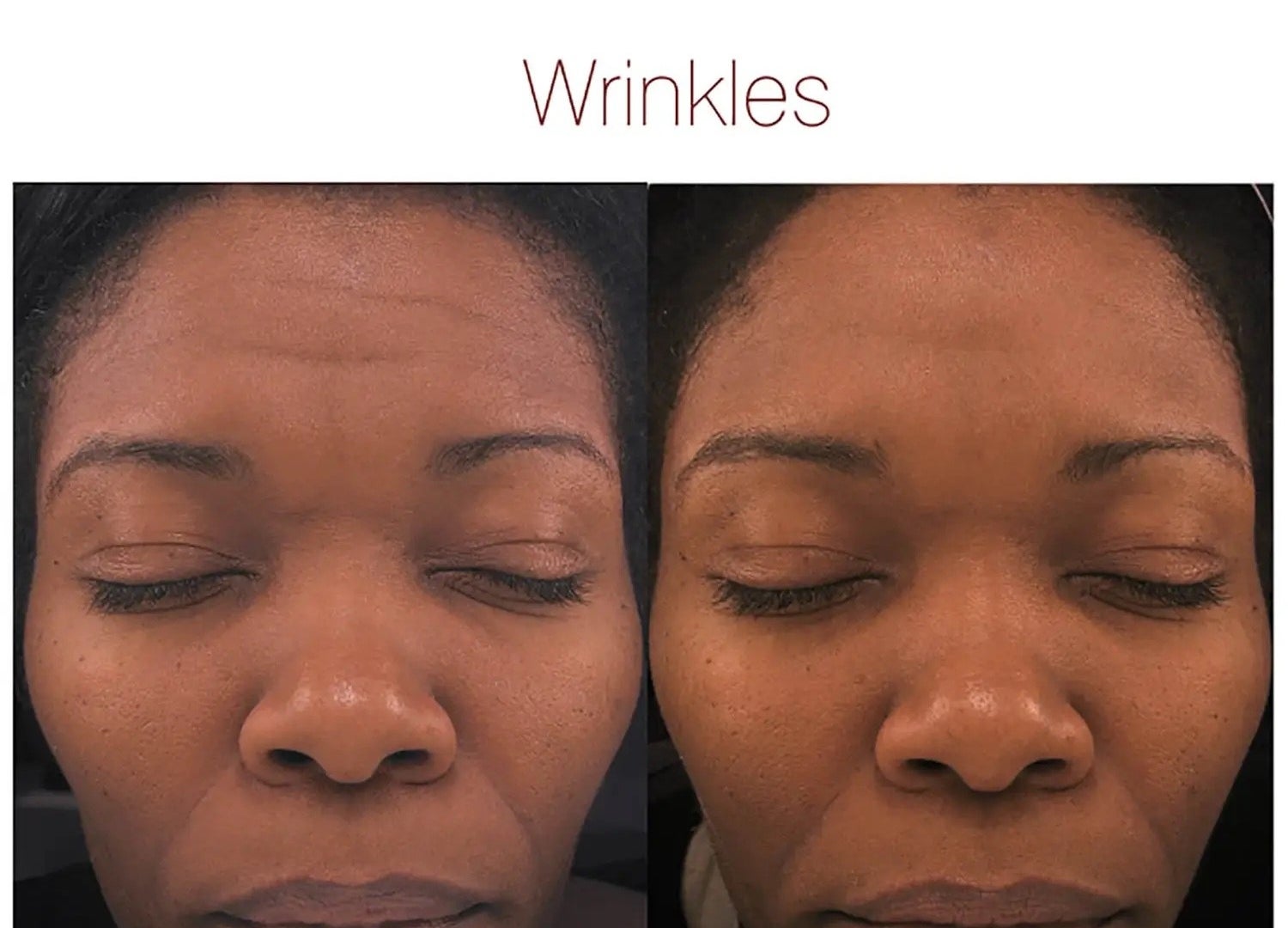 before of person with dull skin and some wrinkles, then after 8 weeks later of their skin looking brighter and wrinkles less noticeable