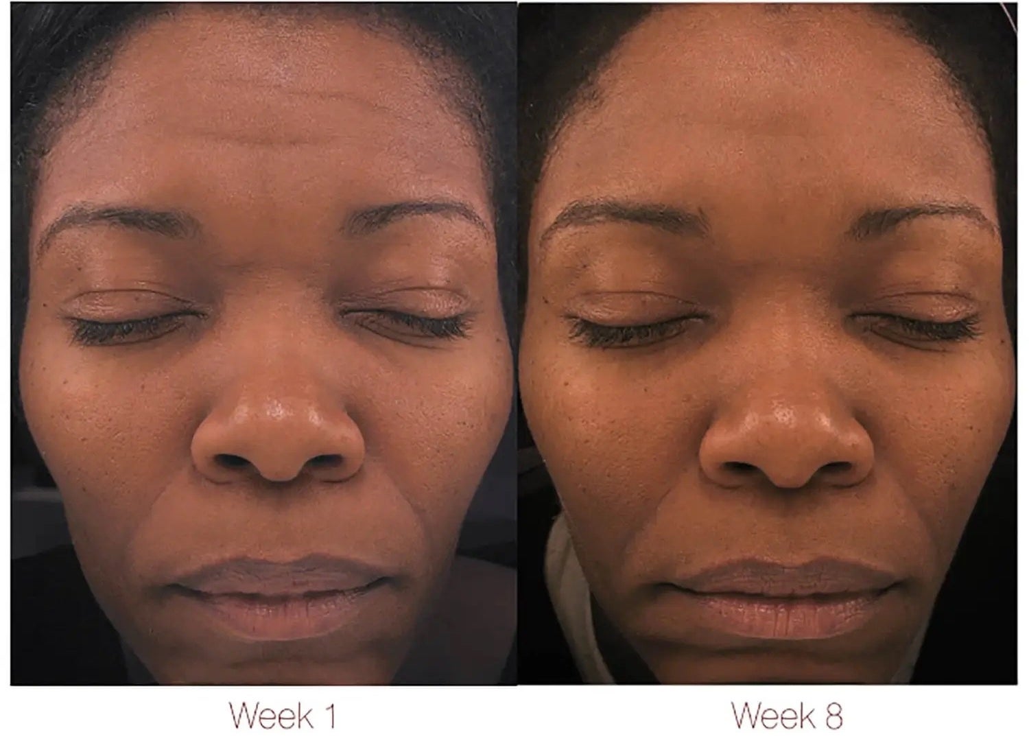 before of person with dull skin and some wrinkles, then after 8 weeks later of their skin looking brighter and wrinkles less noticeable