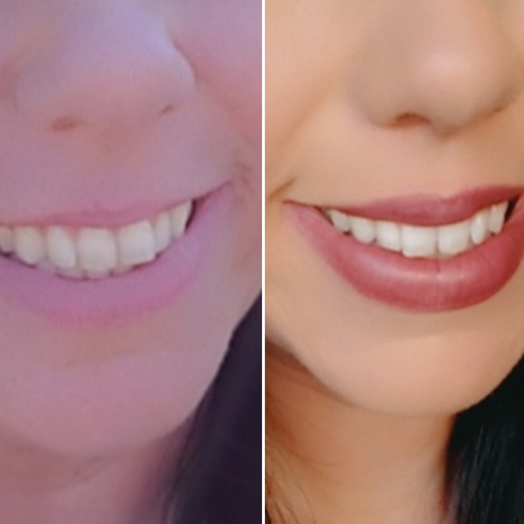 A reviewer&#x27;s before/after showing whiter teeth
