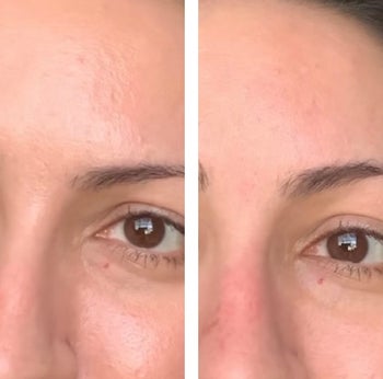 Reviewer showing results of using Revlon volcanic facial roller making their face much more matte