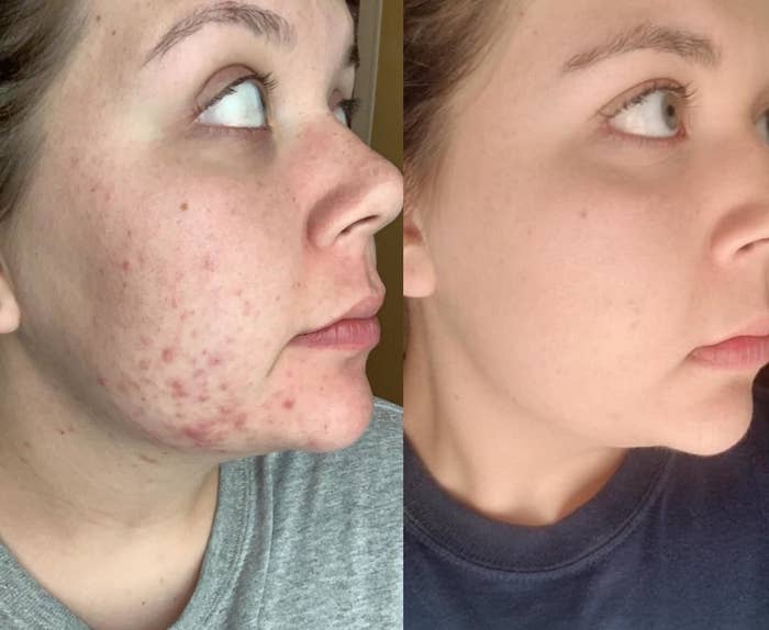 L: a reviewer with acne on their cheeks, R: the same reviewer with much of the acne gone