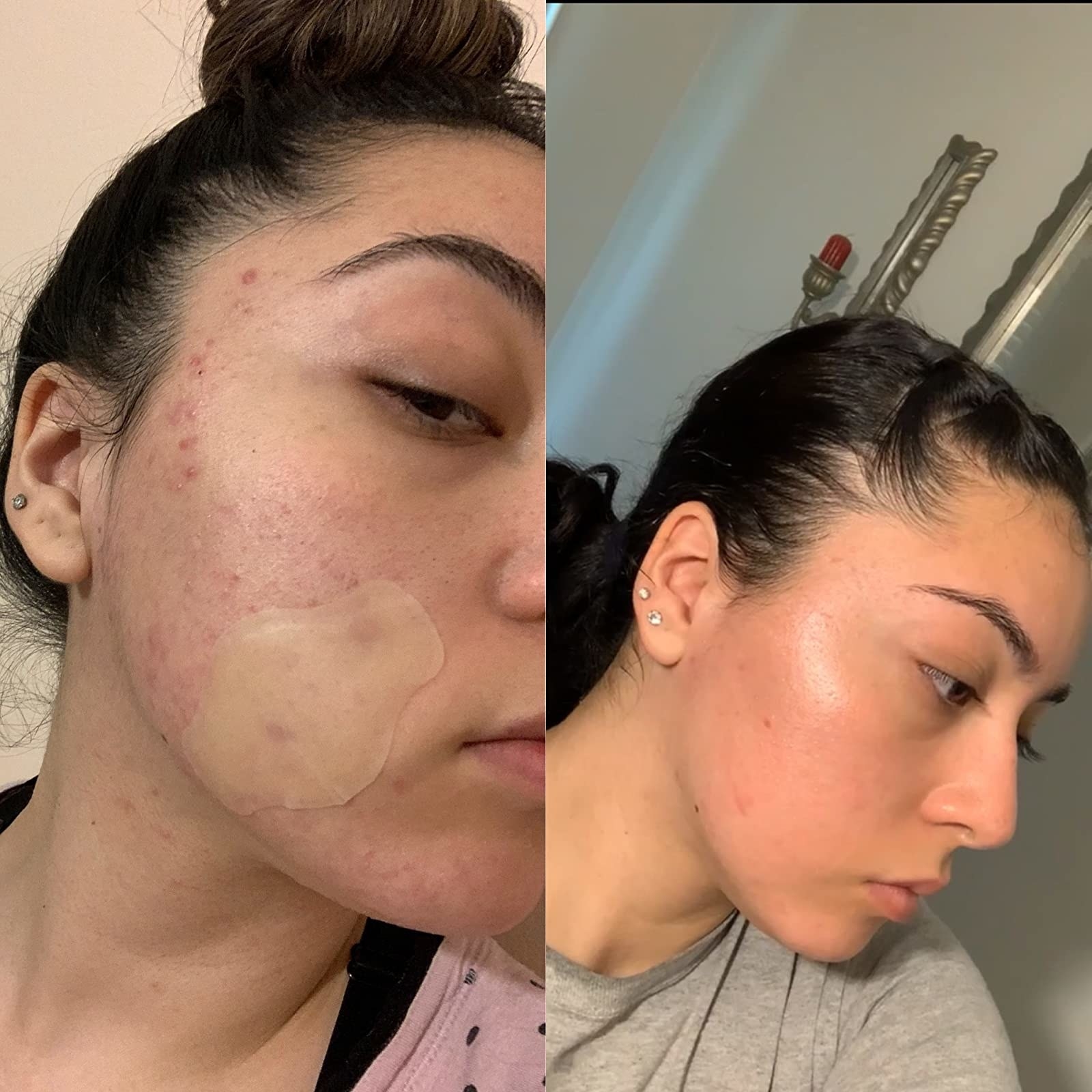reviewer before and after images of reviewer&#x27;s face covered in acne marks and then cleared up