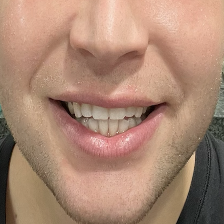 I Got My Teeth Whitened By A Celebrity Dentist