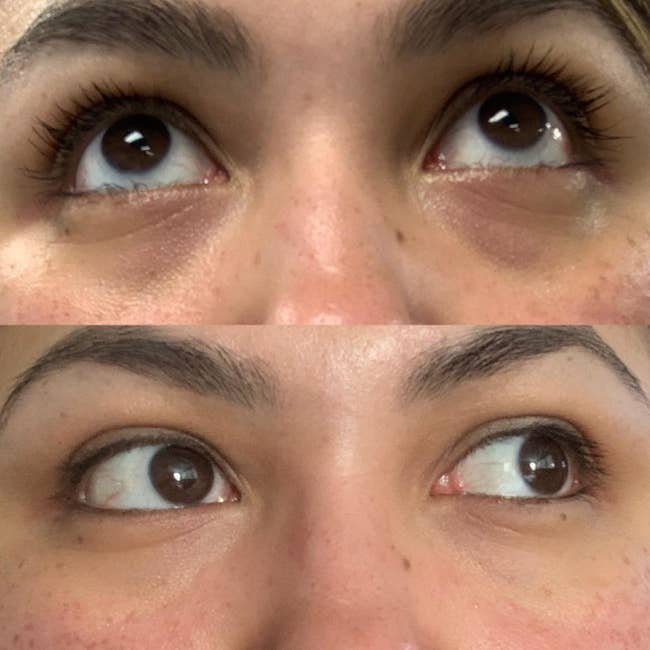 before and after images of a reviewer's dark and saggy under eye area becoming brighter and lifted