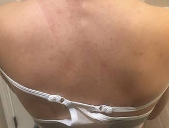 A customer review after photo of their back cleared of acne after one month of using the body wash