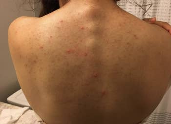 A customer review before photo of their back covered in acne