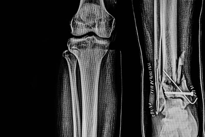 X-ray showing broken leg