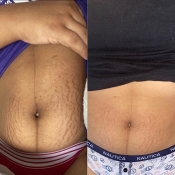 reviewer with dark post-partum stretch marks that have lightened dramatically after using bio oil