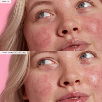 Immediate before and after of person's reduced redness using the serum