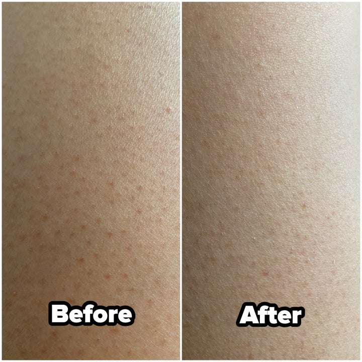 On the left, a tester with visible ingrown hairs and red bumps on their skin labeled "before" and, on the right, the same patch of skin with the looks of bumps reduced labeled "after"