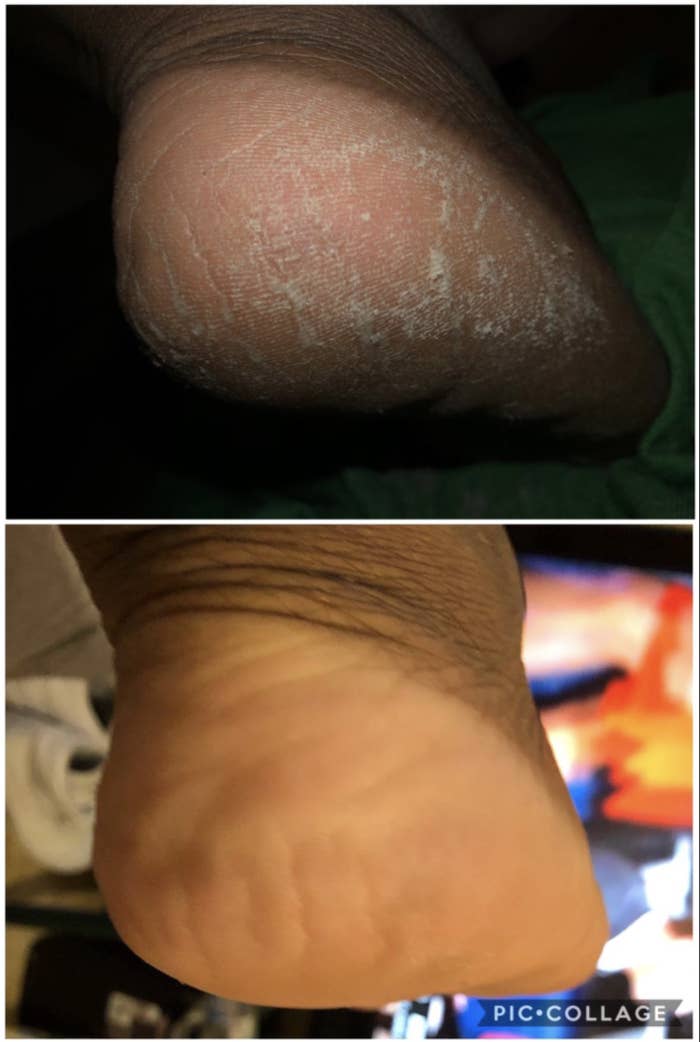 A customer review photo showing their heel before and after using the callus remover