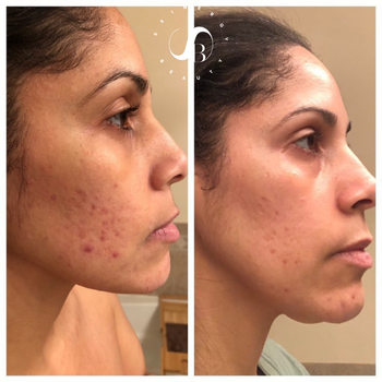 A customer review before and after picture showing clear skin after use of the serum