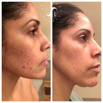 A customer review before and after picture showing clear skin after use of the serum