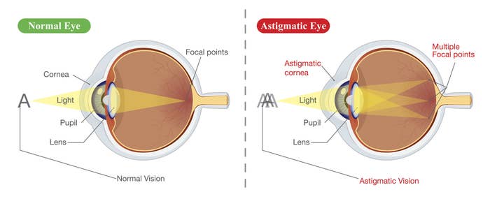 A normal eye diagram and an astigmatic eye diagram