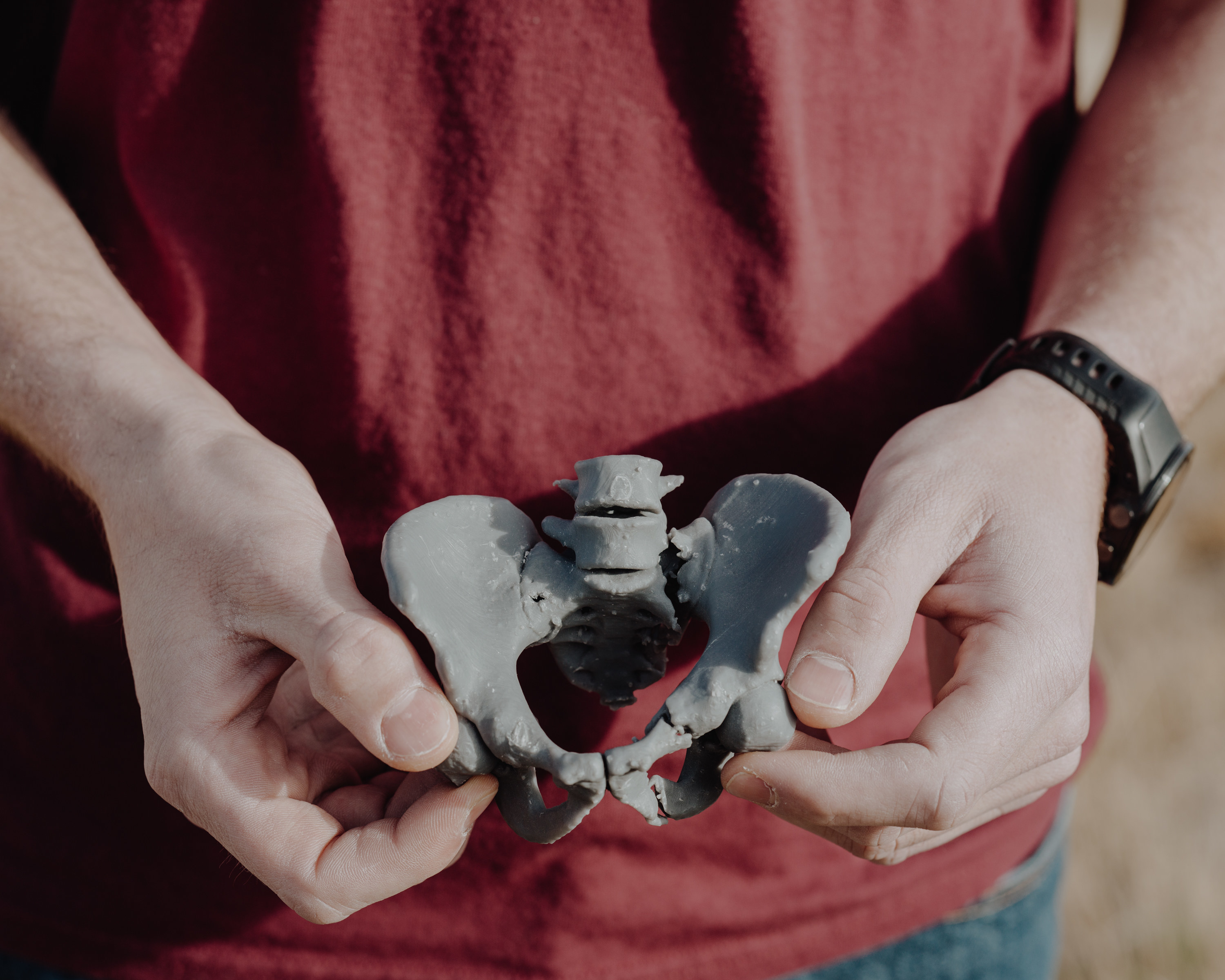 a man holding a model of his broken pelvis in two hands