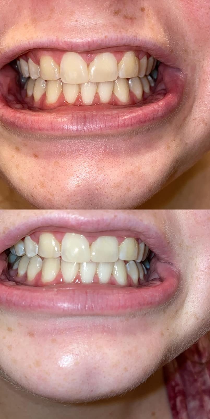 before and after photo showing the reviewer&#x27;s teeth look significantly whiter after using the pen