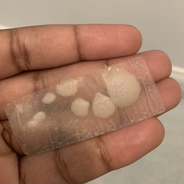 hand holds one of the patches covered in large puss circles lifted from zits on shoulder