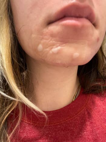 reviewer wears one of the patches on her chin area lifting out gunk from zits
