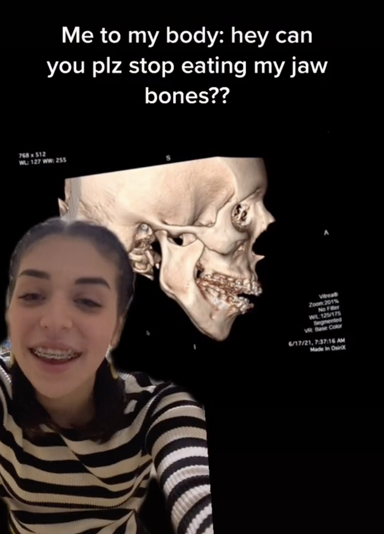 Lilian with the image of a skull in the background with the caption &quot;Me to my body: Hey can you plz stop eating my jaw bones??&quot;