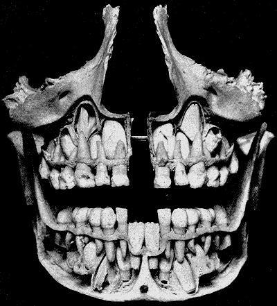 View of double set of teeth inside a skull