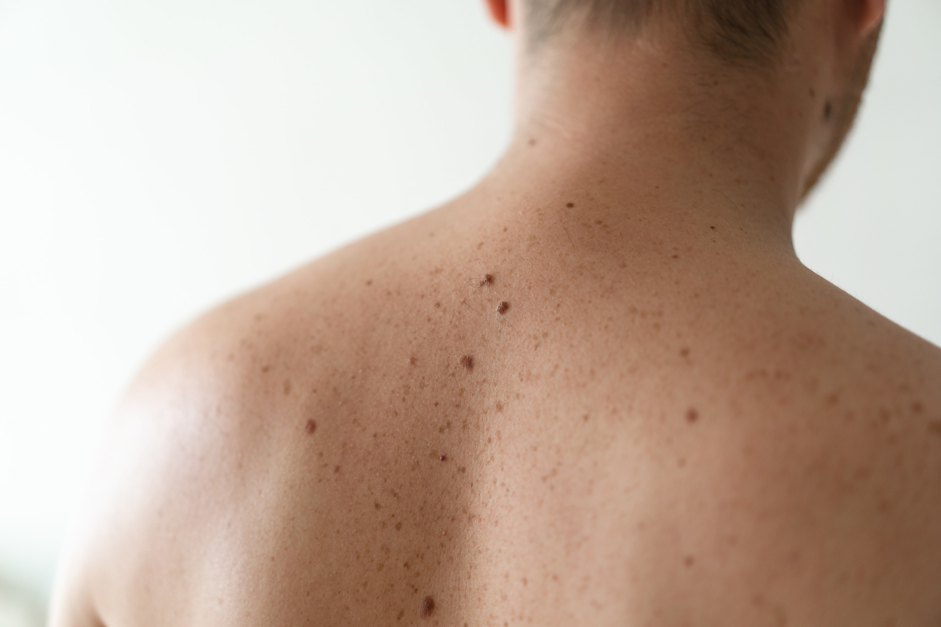 The back of a man&#x27;s back showing all of his moles