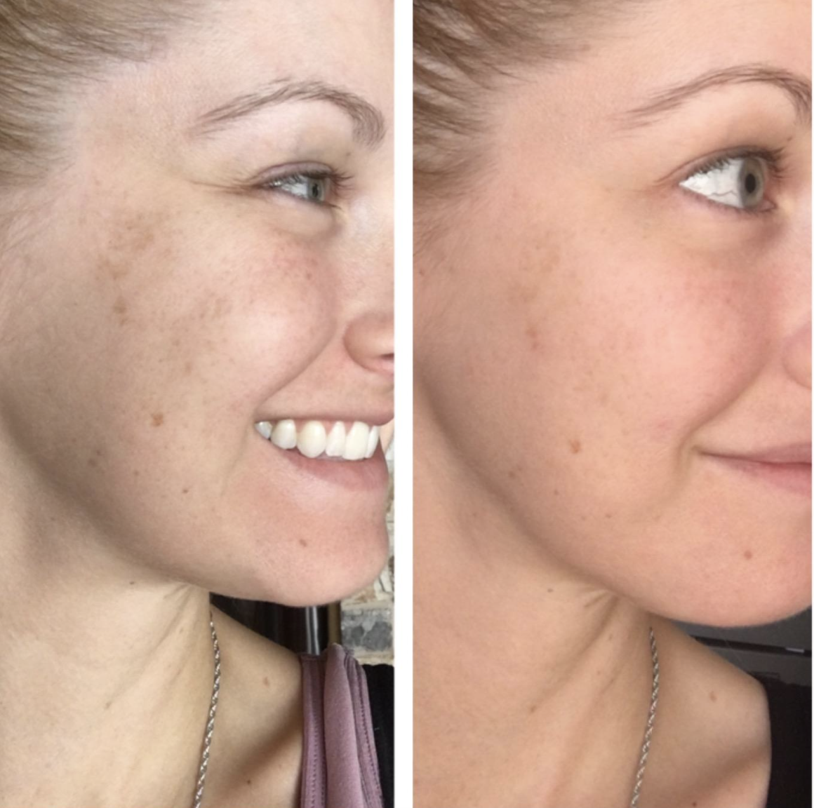 Reviewer showing complexion before and after using the serum