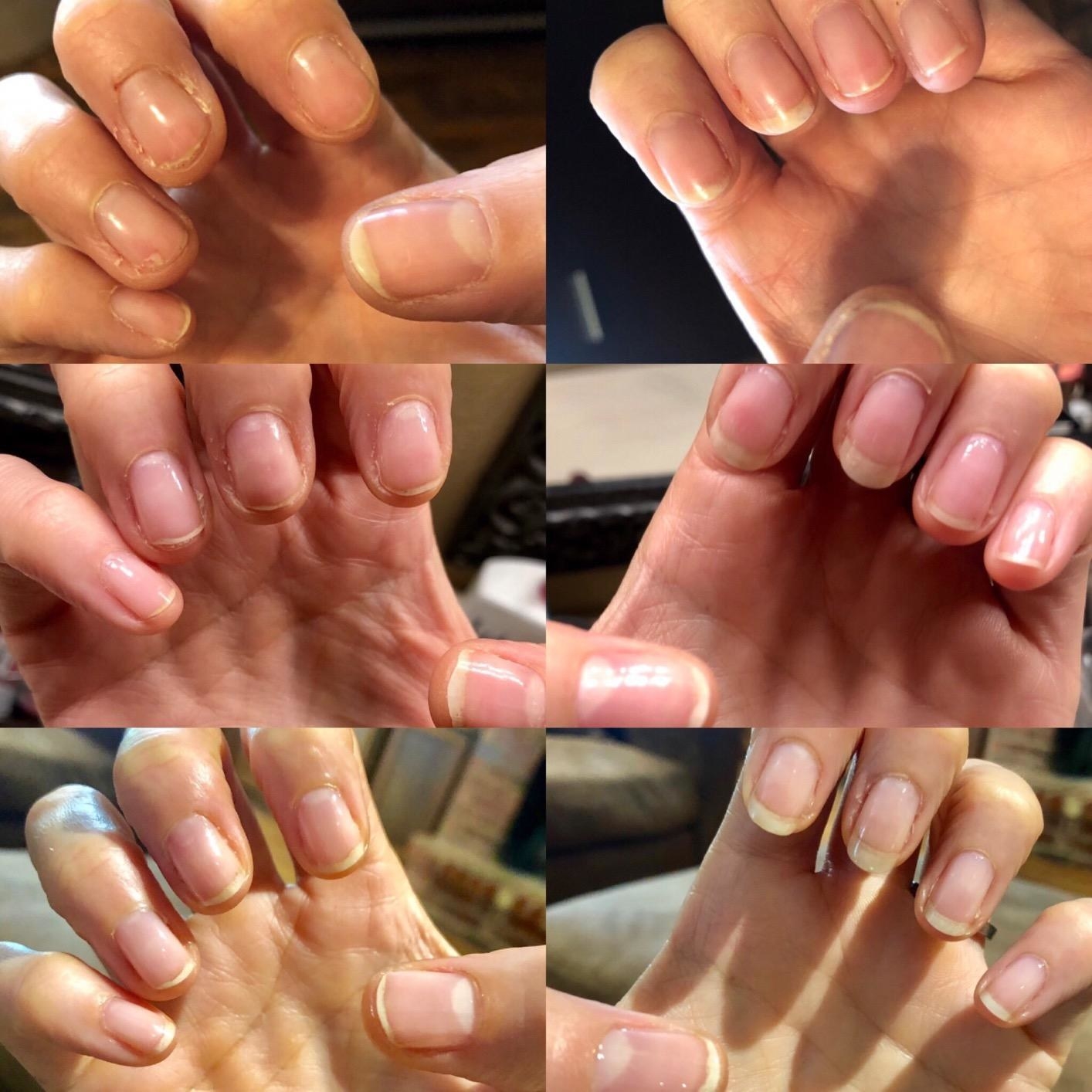 top left to bottom right: time progression of reviewer&#x27;s brittle, chipped nails to same reviewer&#x27;s nails looking stronger and less chipped at a later date