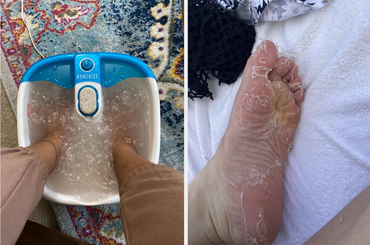 The Best Callus Remover to Get Your Feet Ready for Sandal Weather